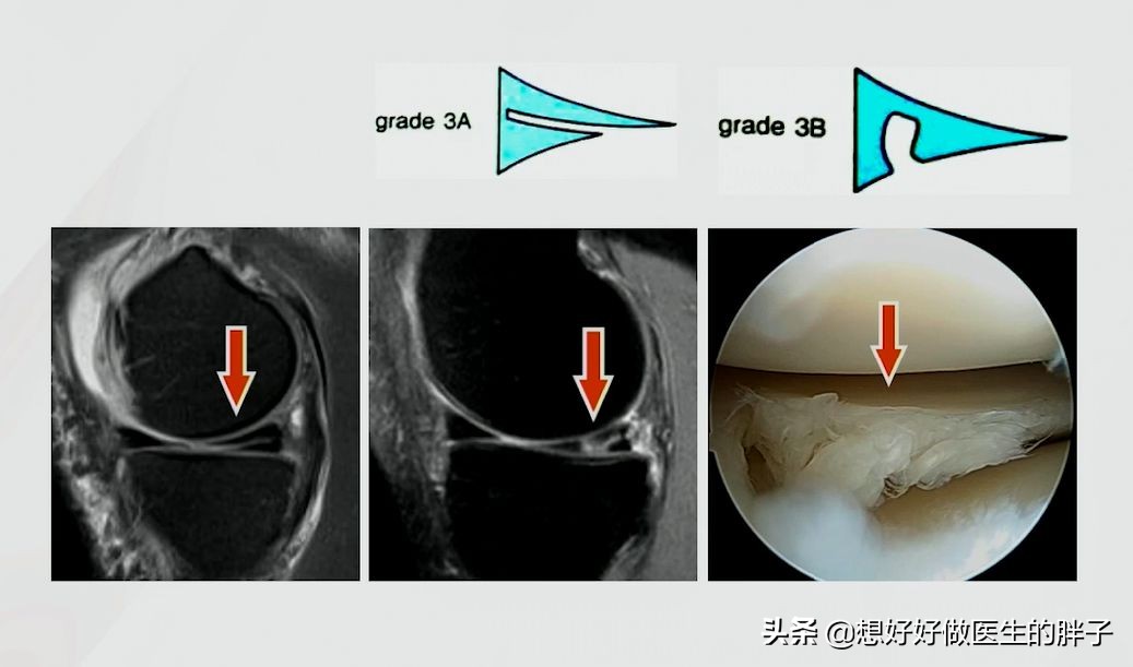足球运动员有半月板问题吗,足球运动员为什么没有半月板
