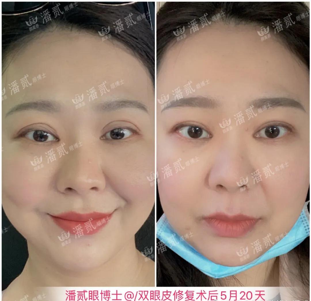 双眼皮修复改扇形双眼皮,平行双眼皮能改成开扇形双眼皮吗