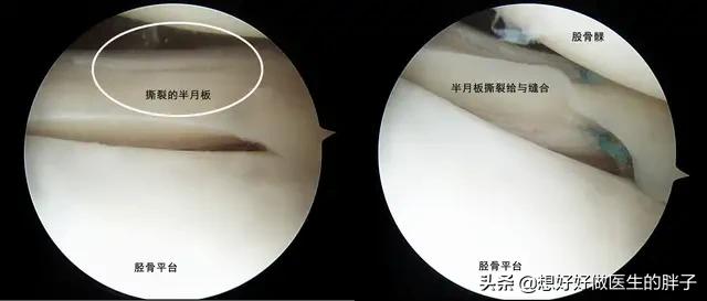 半月板三度撕裂该如何保守治疗,半月板三度撕裂还可以保守治疗吗