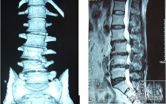 腰痛为啥贴消炎止痛膏药皮肤过敏,经常腰痛肩膀痛贴什么膏药