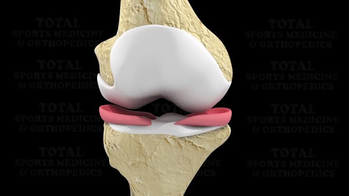 为什么足球运动员不会半月板受伤,足球运动半月板损伤