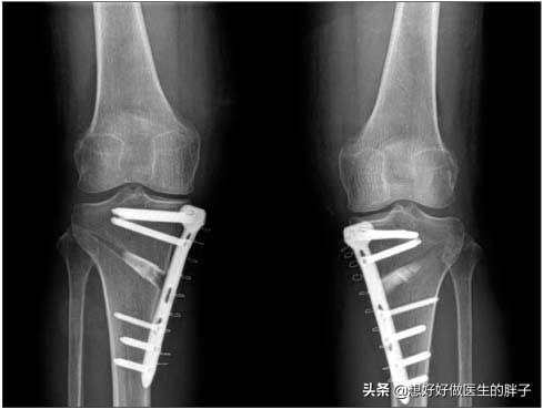 骨刺与骨性关节炎疼痛有什么区别,关节炎骨刺是怎么造成的