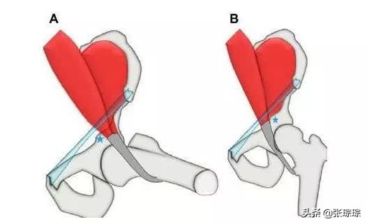 咯噔怎么治疗,髋关节咯噔响是股骨头坏死吗