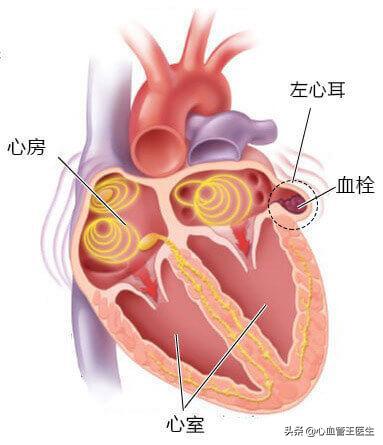 高血压性心脏病科普视频,脑梗死合并房颤如何控制房颤