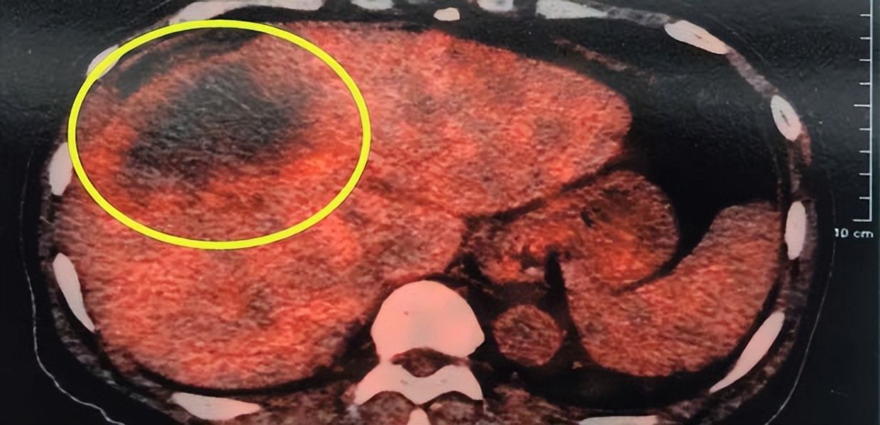 肝癌患者胃老是胀怎么缓解,肝癌晚期胃胀痛难忍还能活多久