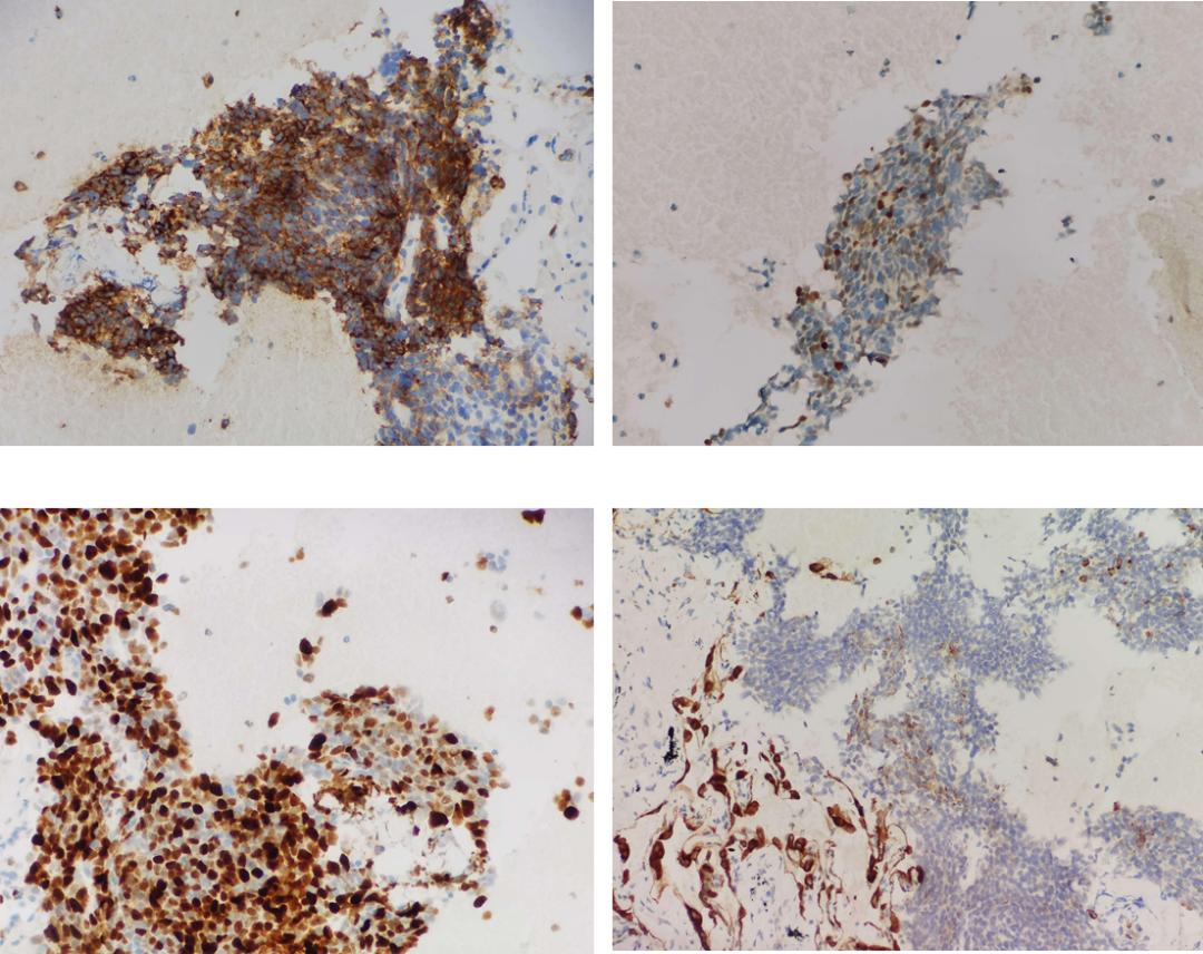 胸口肌肉酸痛皮疹,左肺上叶纵隔旁可见不规则团块影