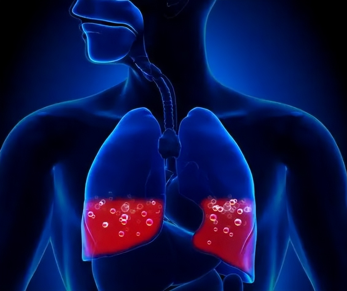 肺部黄痰与白痰区别,痰在肺部怎么形成的