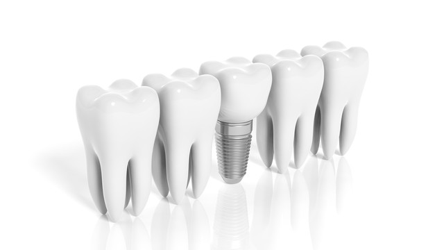 种植牙很多弊端为啥还提倡种牙呢,为什么种牙越来越便宜