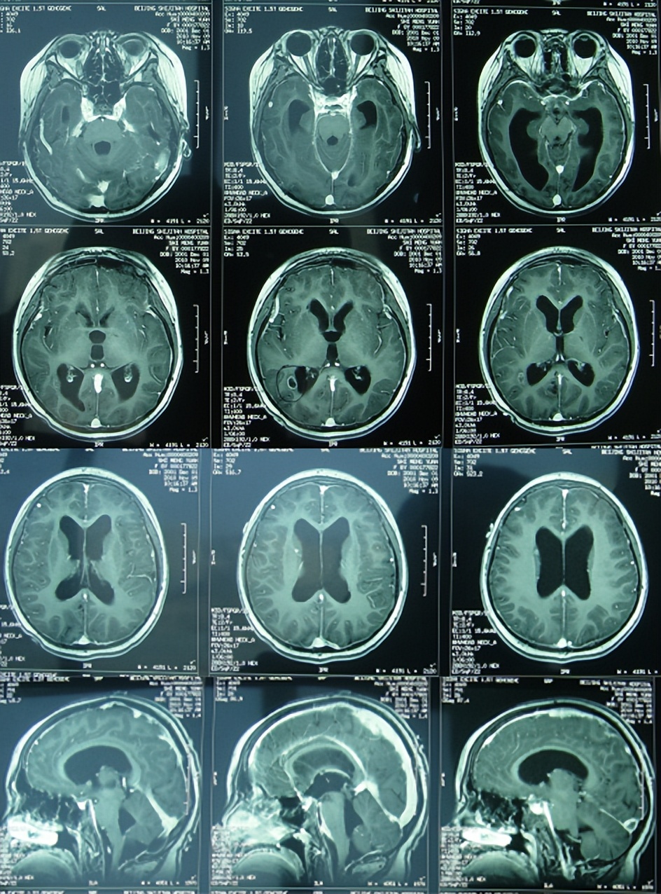 儿童结核脑膜炎脑积水,结核性脑膜炎脑积水如何引起