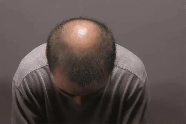 拿什么拯救你我的秀发,拿什么拯救我的秃顶