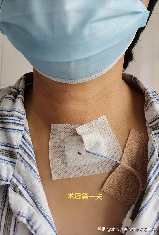 甲状腺手术不留疤痕的方法,甲状腺手术三年疤痕增生会疼吗