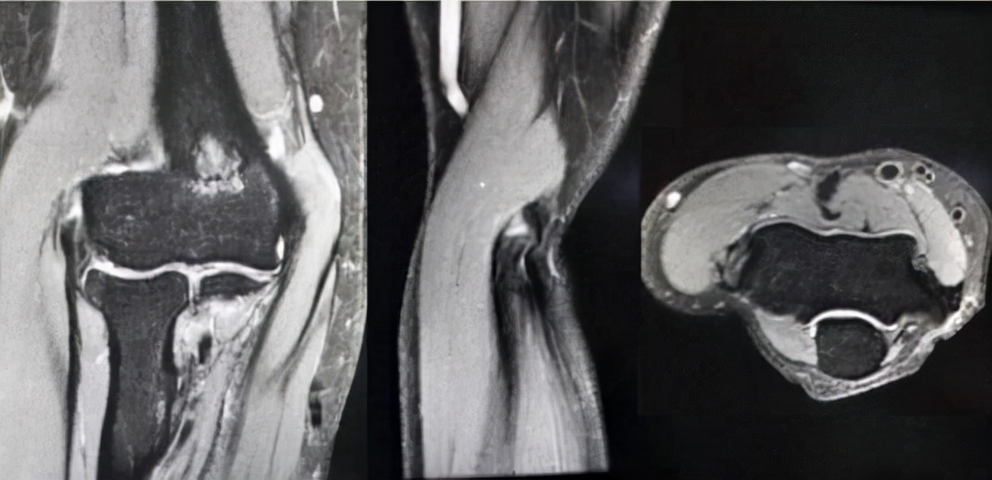网球肘手术需要注意什么,网球肘久治不愈可手术