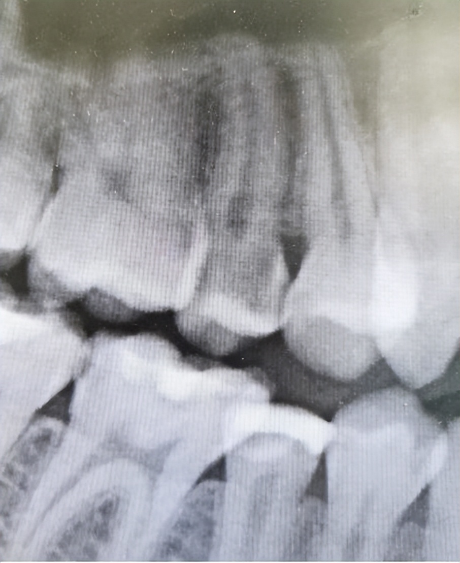 蛀牙不治疗的发展历程,蛀牙一直不治疗