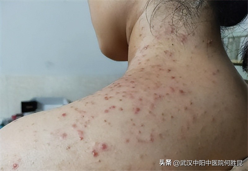肩膀和脖子上长痘痘越来越多,脸上长个痘痘导致脖子上痛怎么办