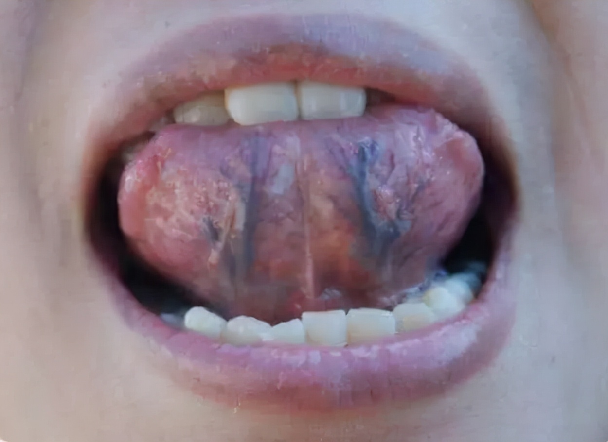 舌头两侧瘀血紫暗是怎么回事,舌头紫暗吃什么调理