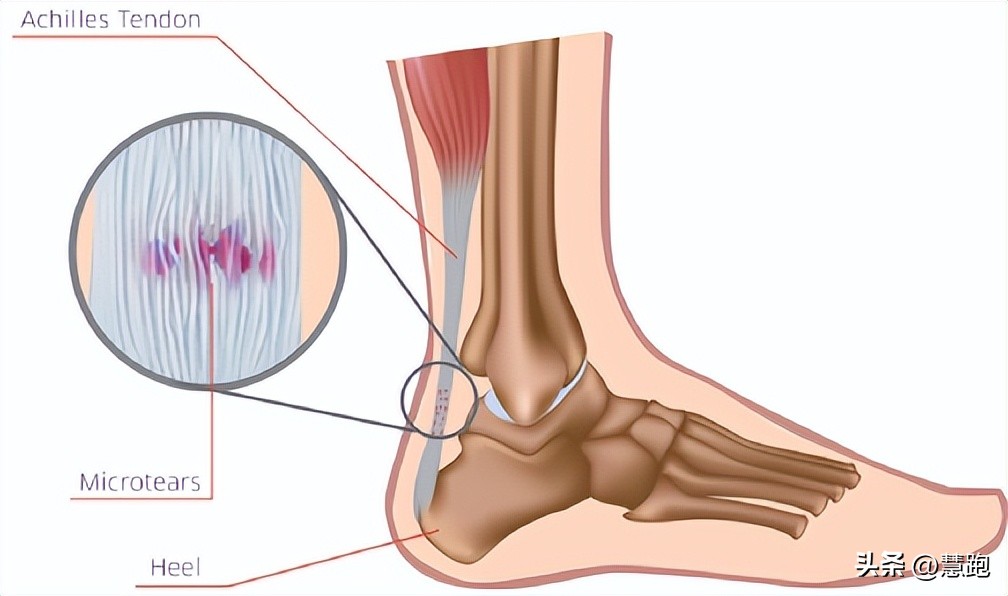 这类顽固性的跑步伤痛最让跑者头疼：4种有效康复方法教你破解