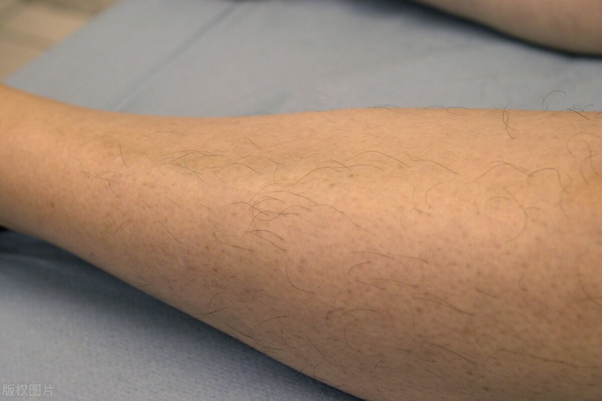 米诺地尔为什么可以治疗脱发,米诺地尔治脱发副作用