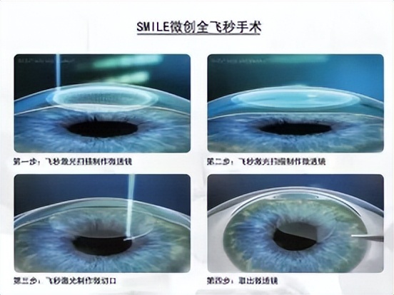 南阳南石眼科医院飞秒做得好吗,南阳南石眼科白内障全飞秒