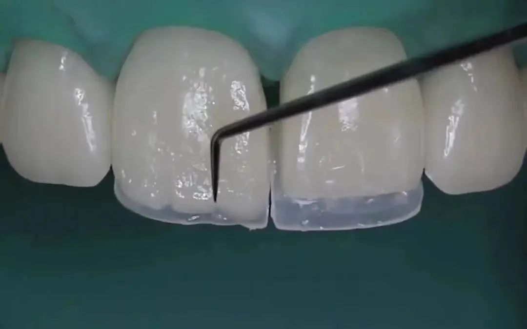 总塞牙怎么彻底解决,老是塞牙缝怎么修补最好