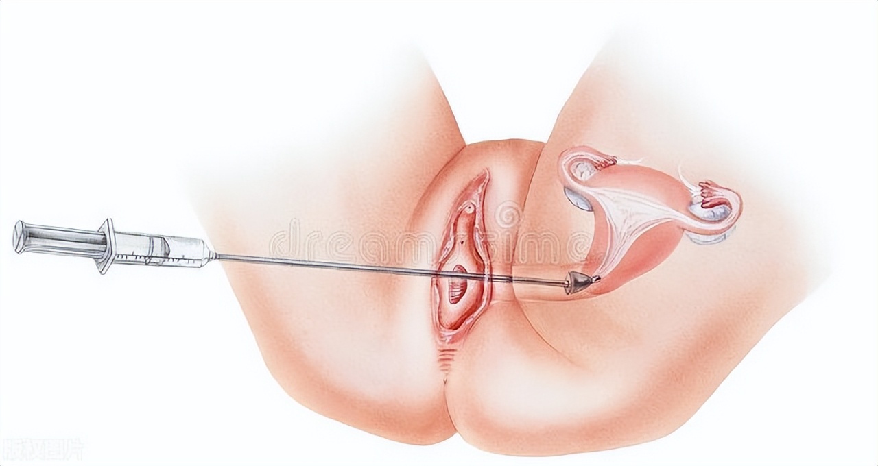 子宫萎缩了宫颈也萎缩吗,子宫开始萎缩一般多大年龄