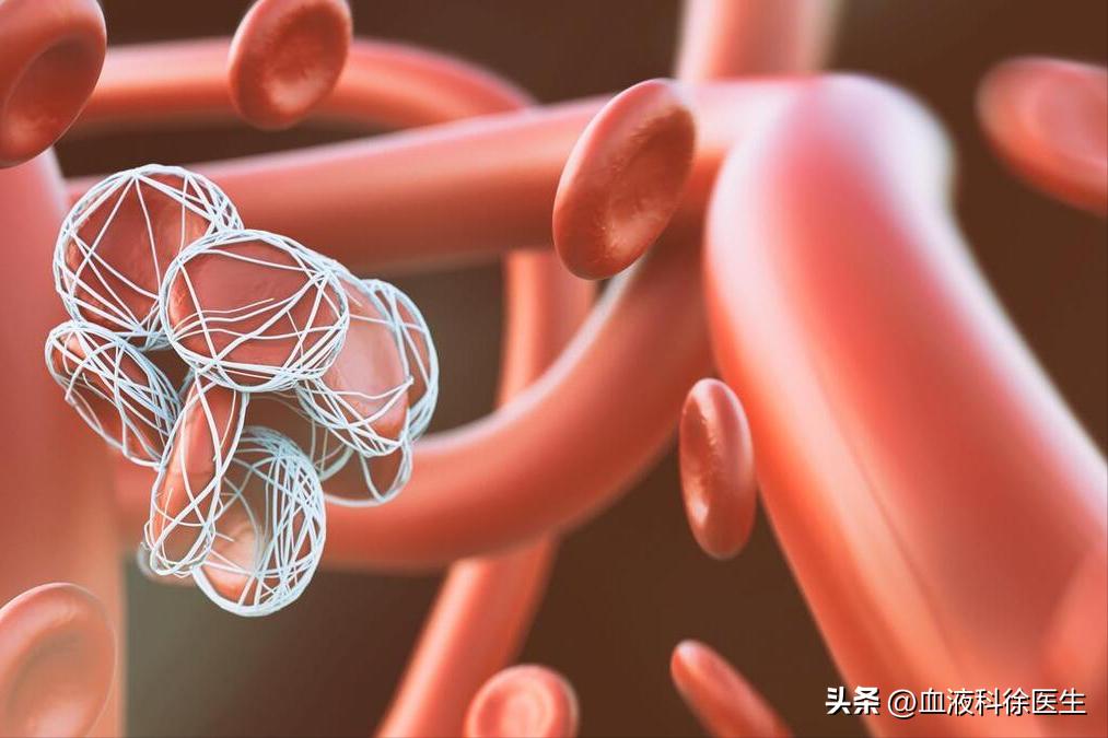 血栓来临腿部先知,血栓病手脚有什么症状