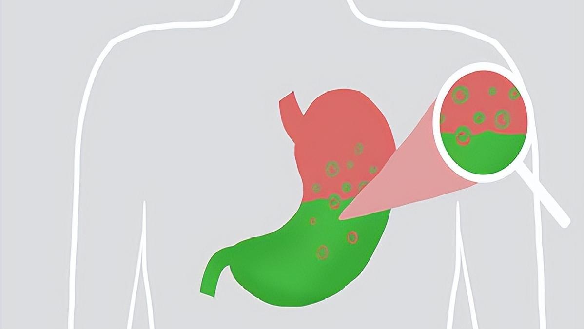 反酸烧心胃反流吃啥中成药好,35岁女性反胃打嗝烧心