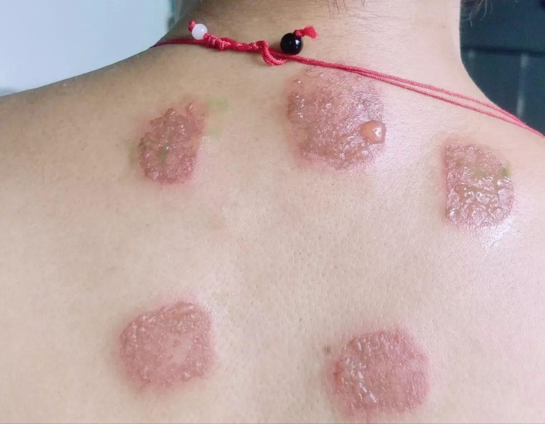 小儿支气管哮喘治疗过程中，配合穴位敷贴护理，收效更佳