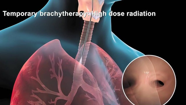 公公得了肺癌一家人还能高兴了吗,公公患癌症去世了