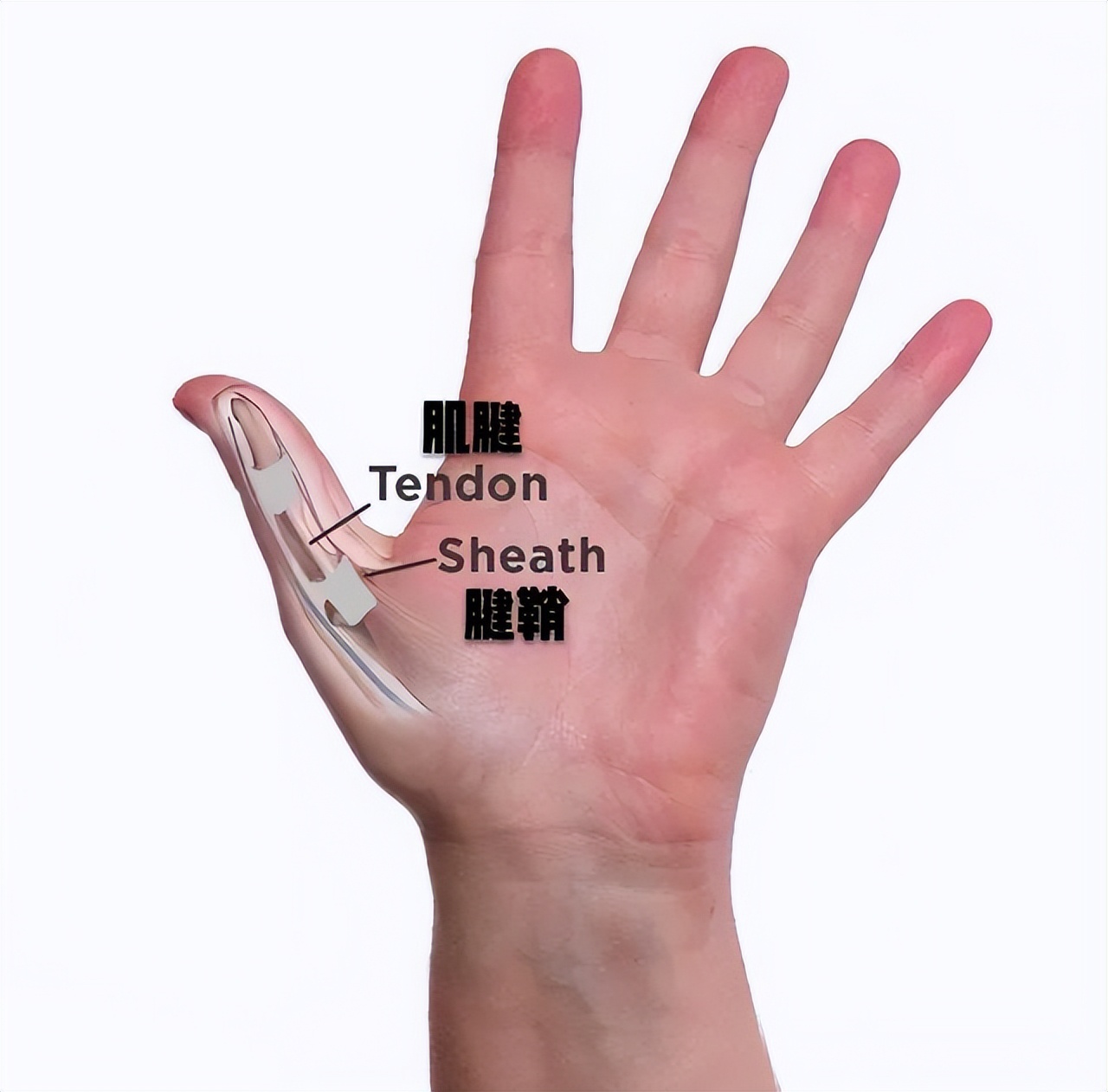 桡骨狭窄性腱鞘炎热敷还是冰敷,中指腱鞘炎是热敷还是冰敷