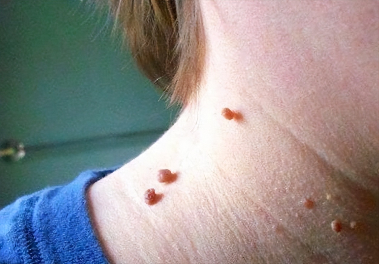 脖子上有包块是怎么回事,脖子上的丝状疣怎么去除