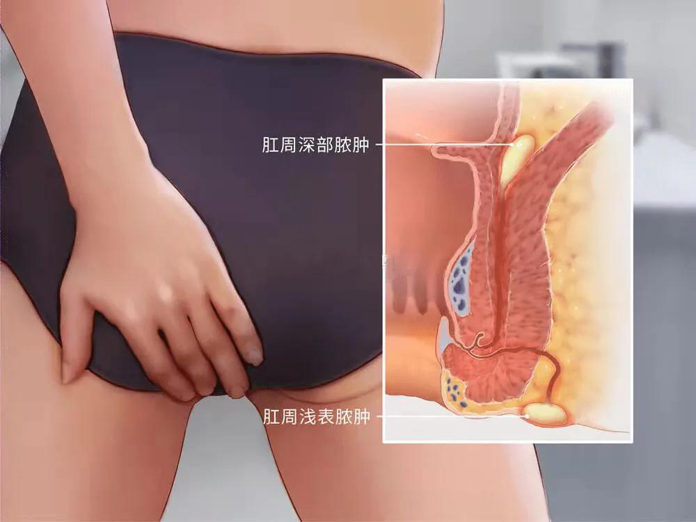 肛周脓肿溃破后可以用高锰酸钾吗,肛周脓肿自行溃破好吗