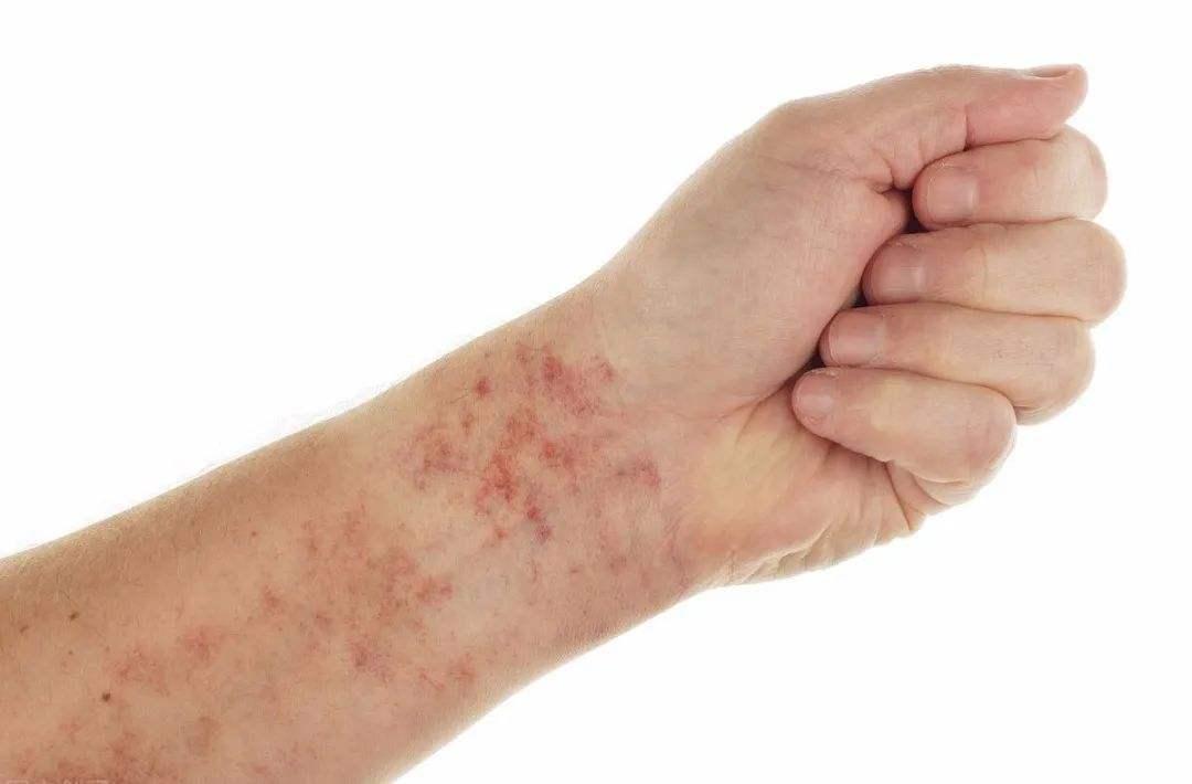 肝硬化代偿期手臂有小红点脂肪粒,肝硬化出现小红点可以自己消失吗