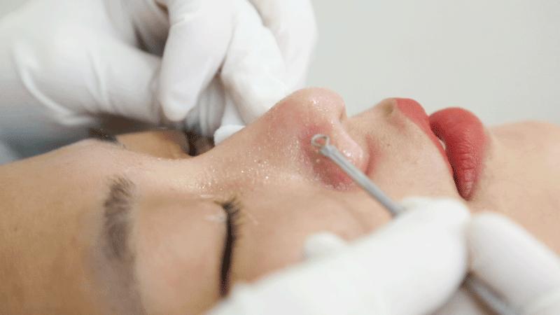 额头眉心发红有闭口粉刺,眉心鼻头频繁起粉刺怎么办