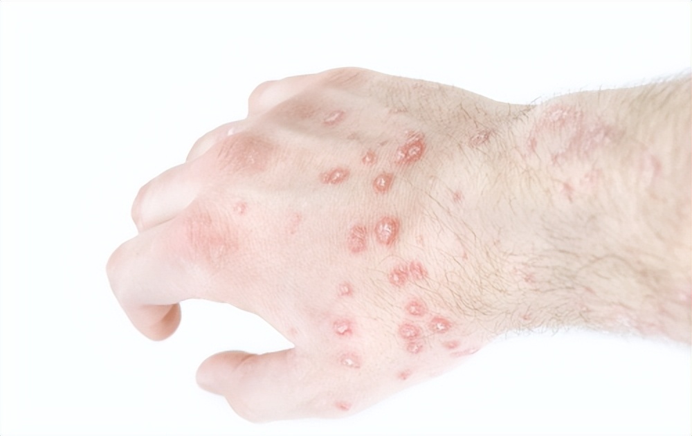 皮炎湿疹后留下的白斑是白癜风吗,湿疹后得的白癜风好治吗