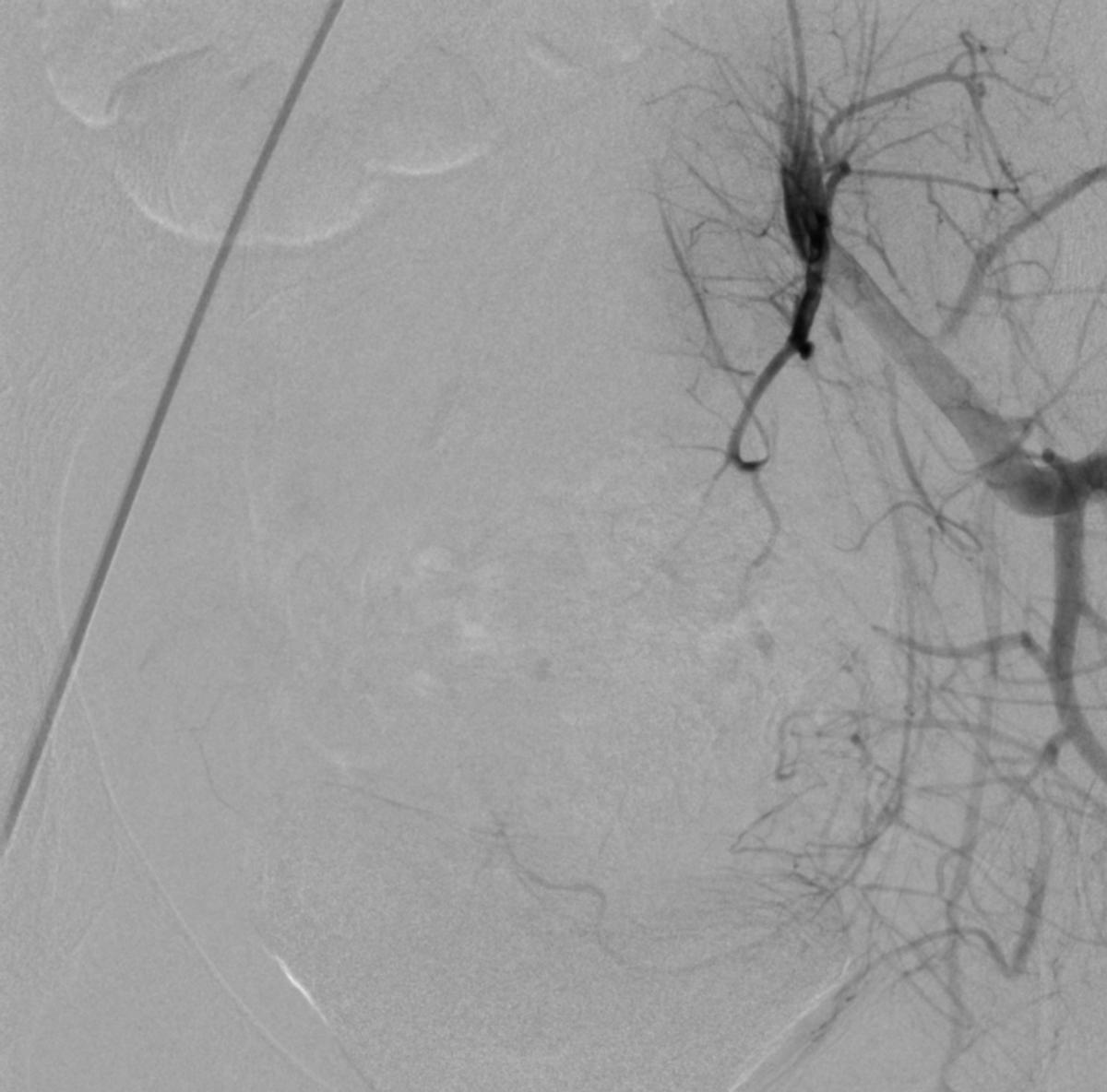 14岁女孩非经期出血,14岁女孩非月经期出血是怎么回事