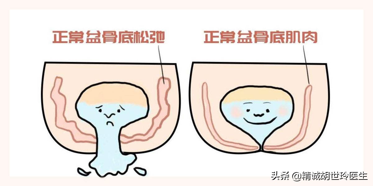 盆底肌无力适合顺产吗,盆底肌未恢复可以怀孕吗