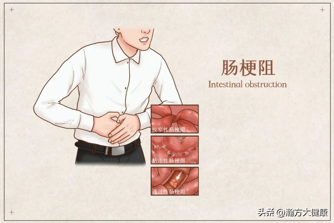 预防肠道疾病的十个方法,肠道受损是什么症状