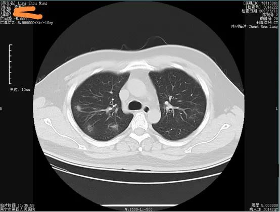 新冠复阳会感染吗,新冠复阳还是二次感染