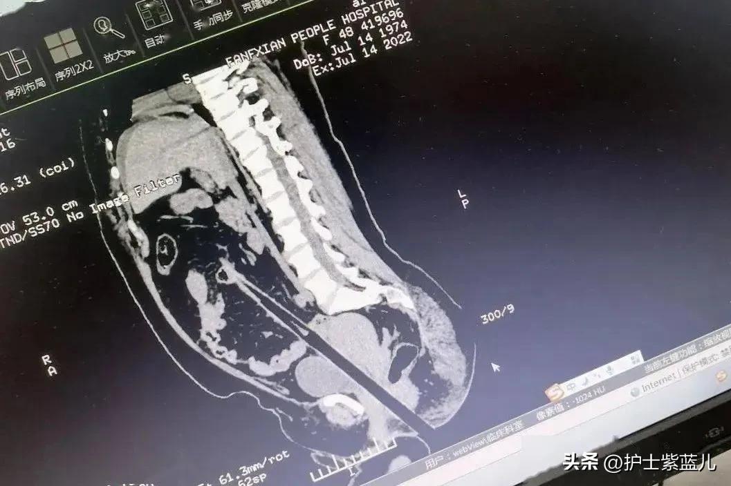 老人不慎从楼梯上重重摔下,老人意外从楼上摔下来