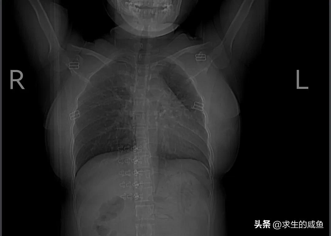 肺部感染住院费一天多少钱,肺部感染住院15天一般多少钱