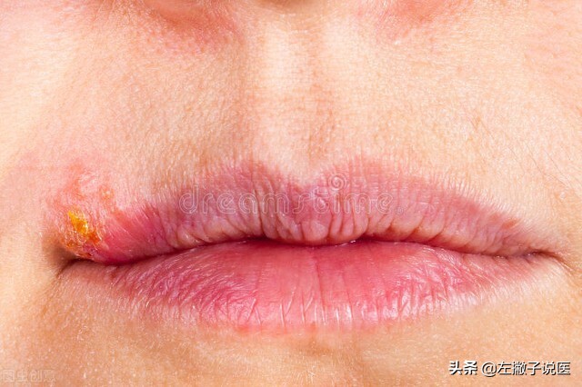 嘴唇起泡是细菌感染还是病毒,嘴唇起水泡一般是什么病毒感染的