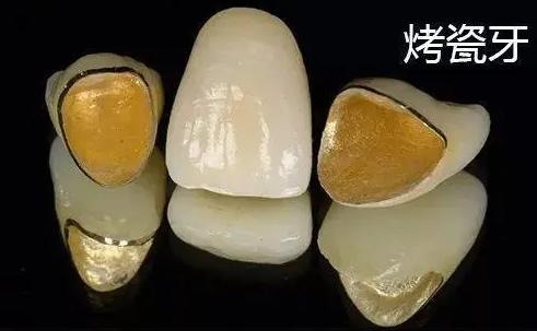 全瓷牙和烤瓷牙哪个质量好一点,全瓷牙和烤瓷牙的图片对比