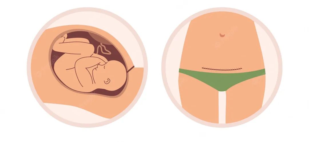 剖宫产切口选择哪个部位较好,剖宫产多久切口才会长好