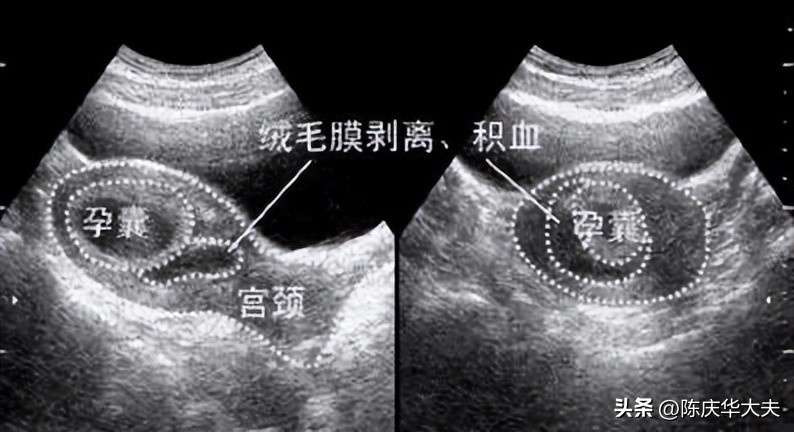 孕酮低孕囊旁有积液,孕囊旁暗区积液