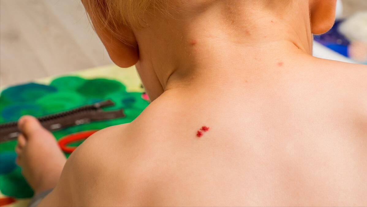 孩子身上的胎记是血管瘤吗,儿童面部红斑胎记