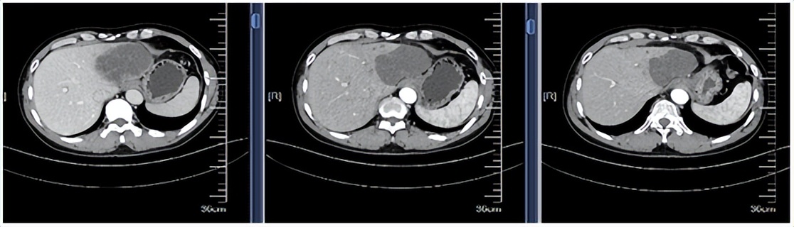 肝内胆管细胞癌免疫治疗成功案例,pbl治疗肝内胆管癌晚期转移有效吗
