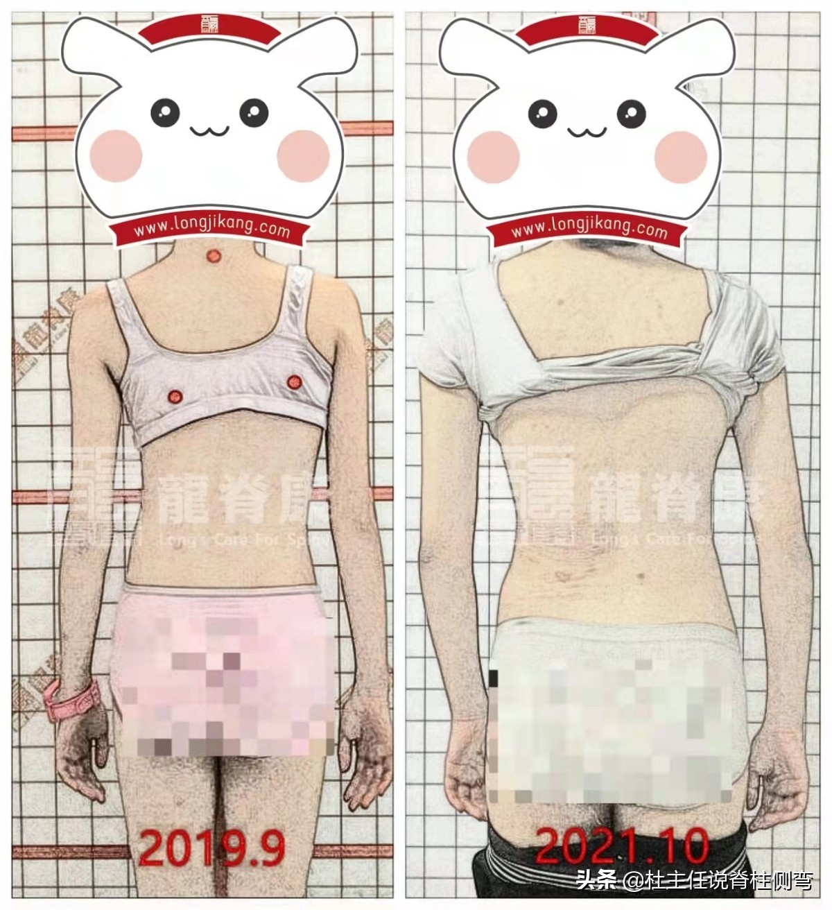 40多岁脊柱侧弯能戴矫正器吗,s弯脊柱侧弯40度要手术吗