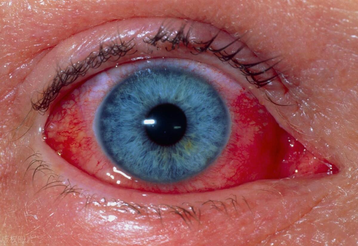 人体有癌细胞眼睛会出现哪些症状,眼睛是癌细胞的感应器