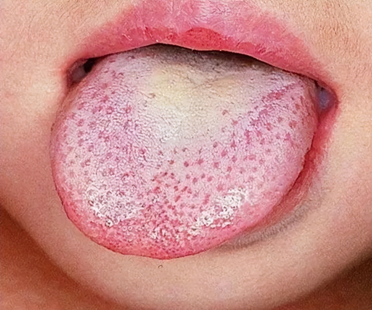 小孩的舌头出现小红点点,小儿舌头的各种症状如何解决