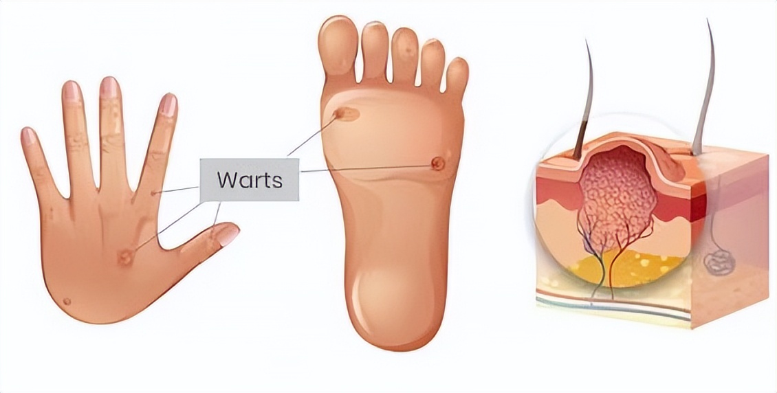 对hpv的误解科普,关于hpv一定要知道的9大误区